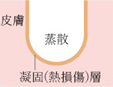 フラクショナルレーザーのイメージ