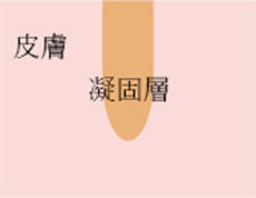 ノンアブレーティブレーザーのイメージ