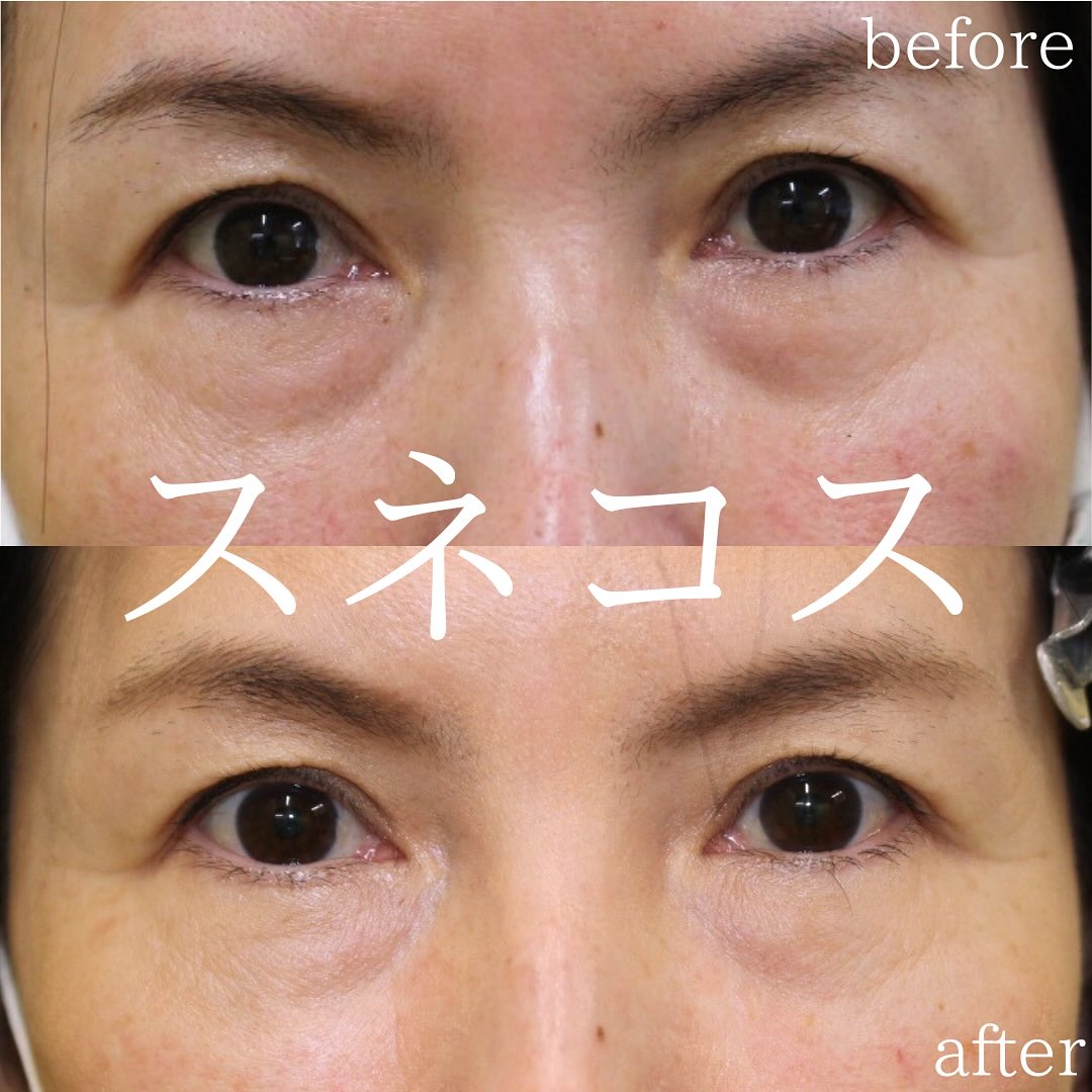 スネコス注射の症例写真・画像・術後・ビフォーアフター1