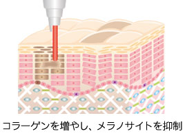 コラーゲンを増やし、メラノサイトを抑制