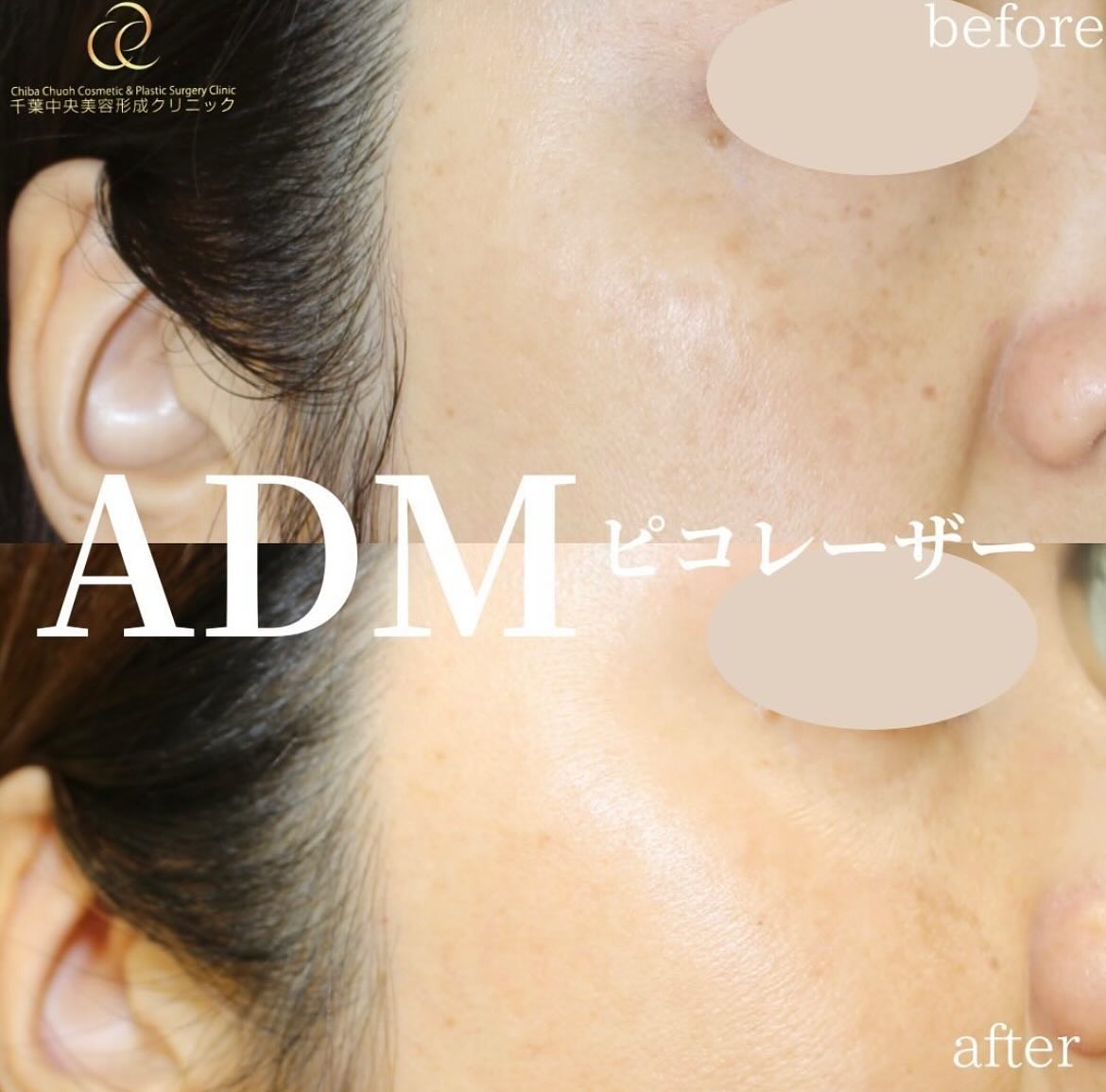 ピコレーザーによるADM治療の症例写真・画像・術後・ビフォーアフター