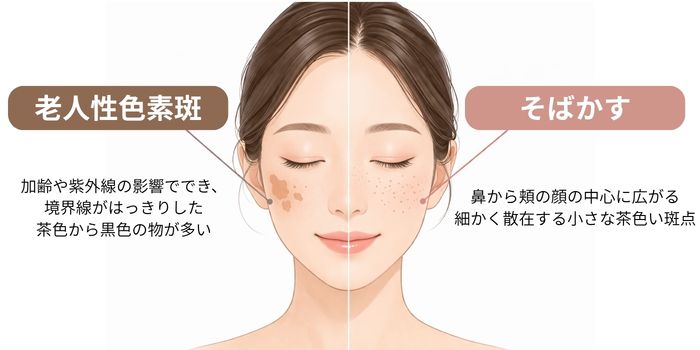 老人性色素斑 そばかす