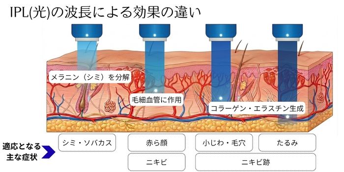 IPL（光）の波長による効果の違い