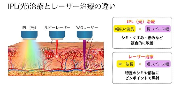 IPL（光）治療とレーザー治療の違い