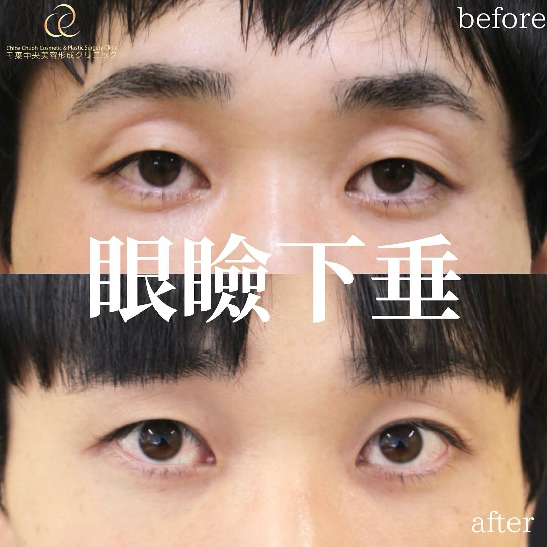 眼形下垂手術(切開法)｜20代男性｜術後1ヶ月半