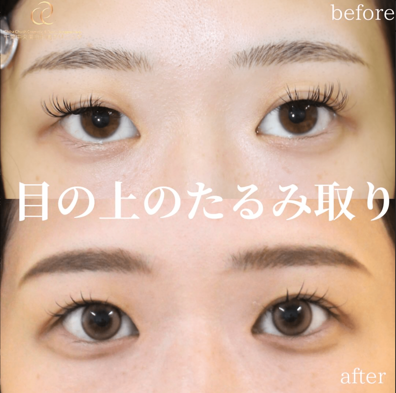 全切開法＋目の上のたるみ除去＋眼瞼下垂手術（埋没法）＋PRP｜20代女性｜術後3ヶ月