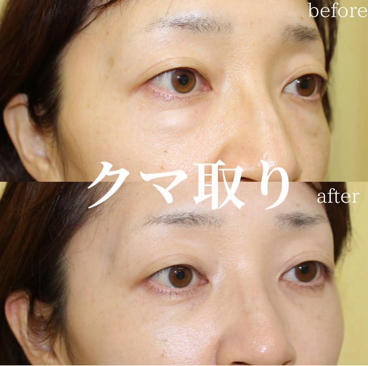 目の下の切らないクマ取り＋PRP｜40代女性｜術後1ヶ月