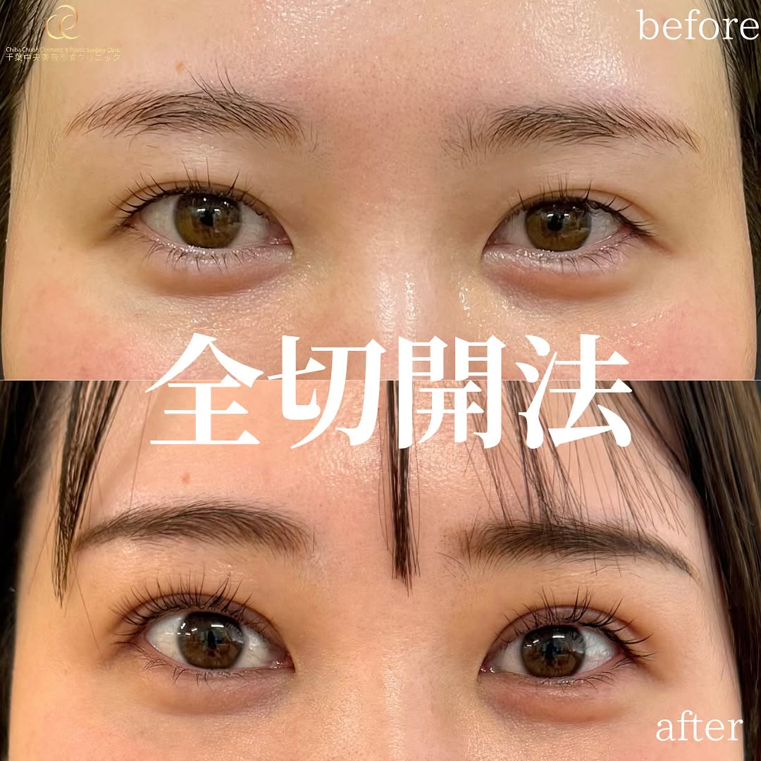 全切開法＋眼瞼下垂手術(埋没法)｜20代女性｜術後3週間