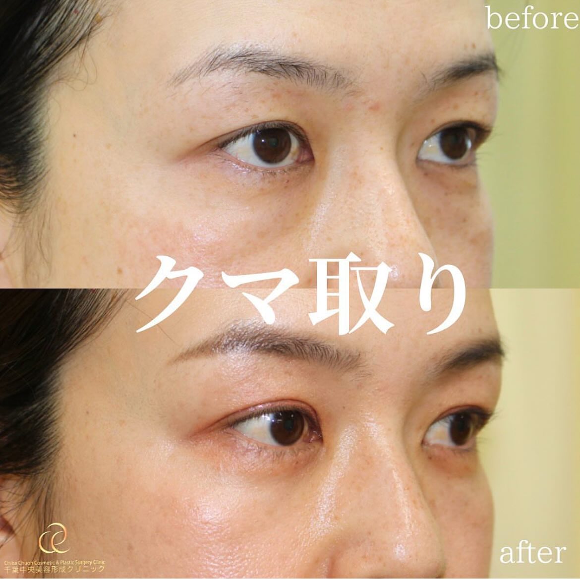 目の下の切らないクマ取り＋PRP｜40代女性｜術後1ヶ月