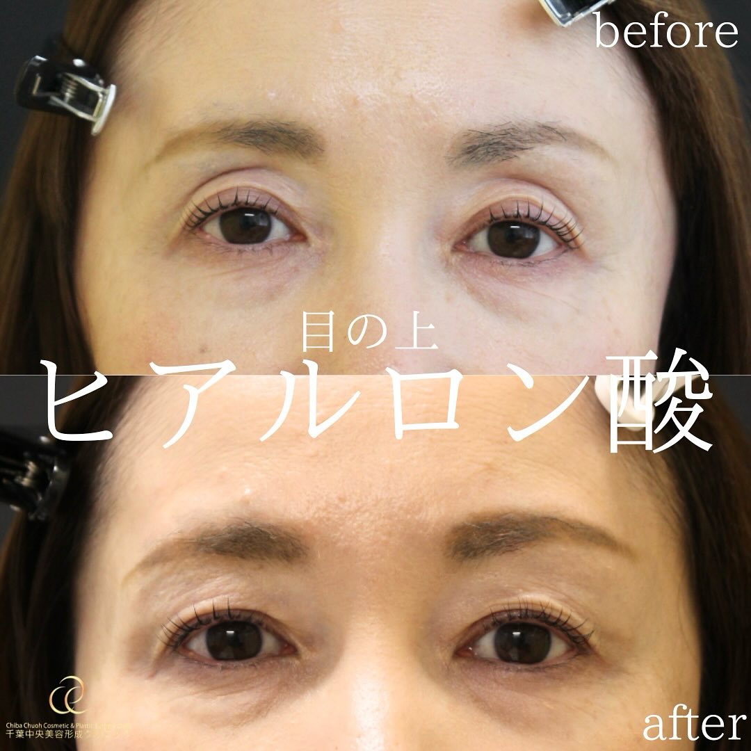 目の上のヒアルロン酸注入｜40代女性｜術後2週間