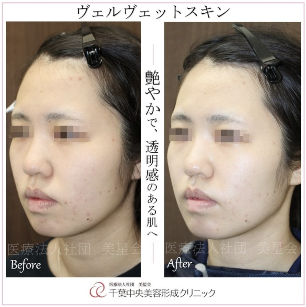 ヴェルヴェットスキン｜術前と8日後｜症例写真