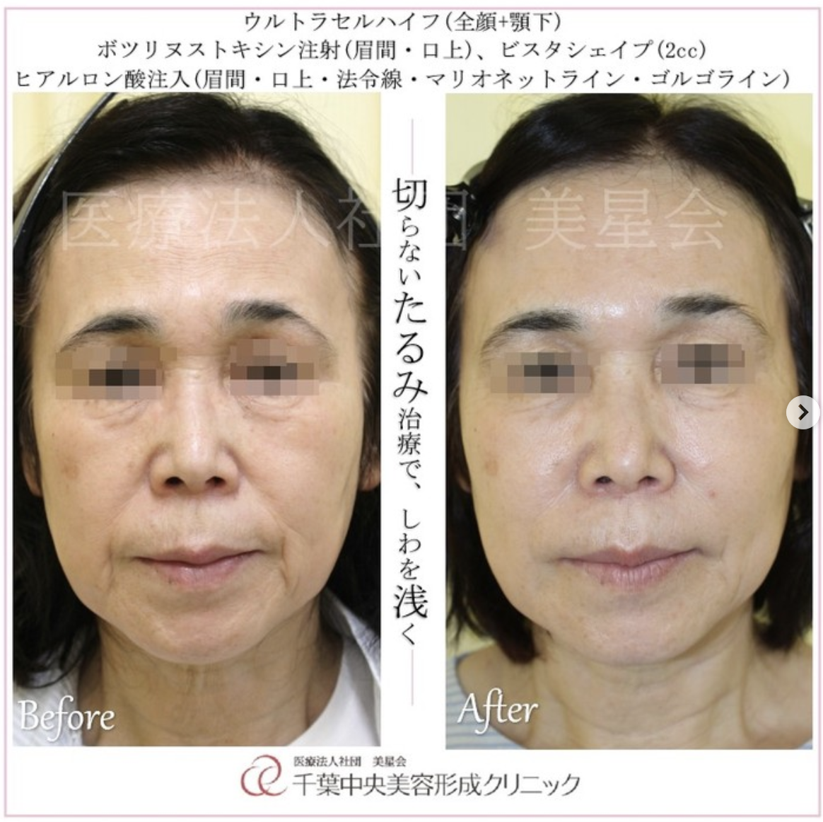 ウルトラセルハイフ・ボツリヌストキシン注射・ビスタシェイプ・ヒアルロン酸注入｜症例写真｜ビフォーアフター
