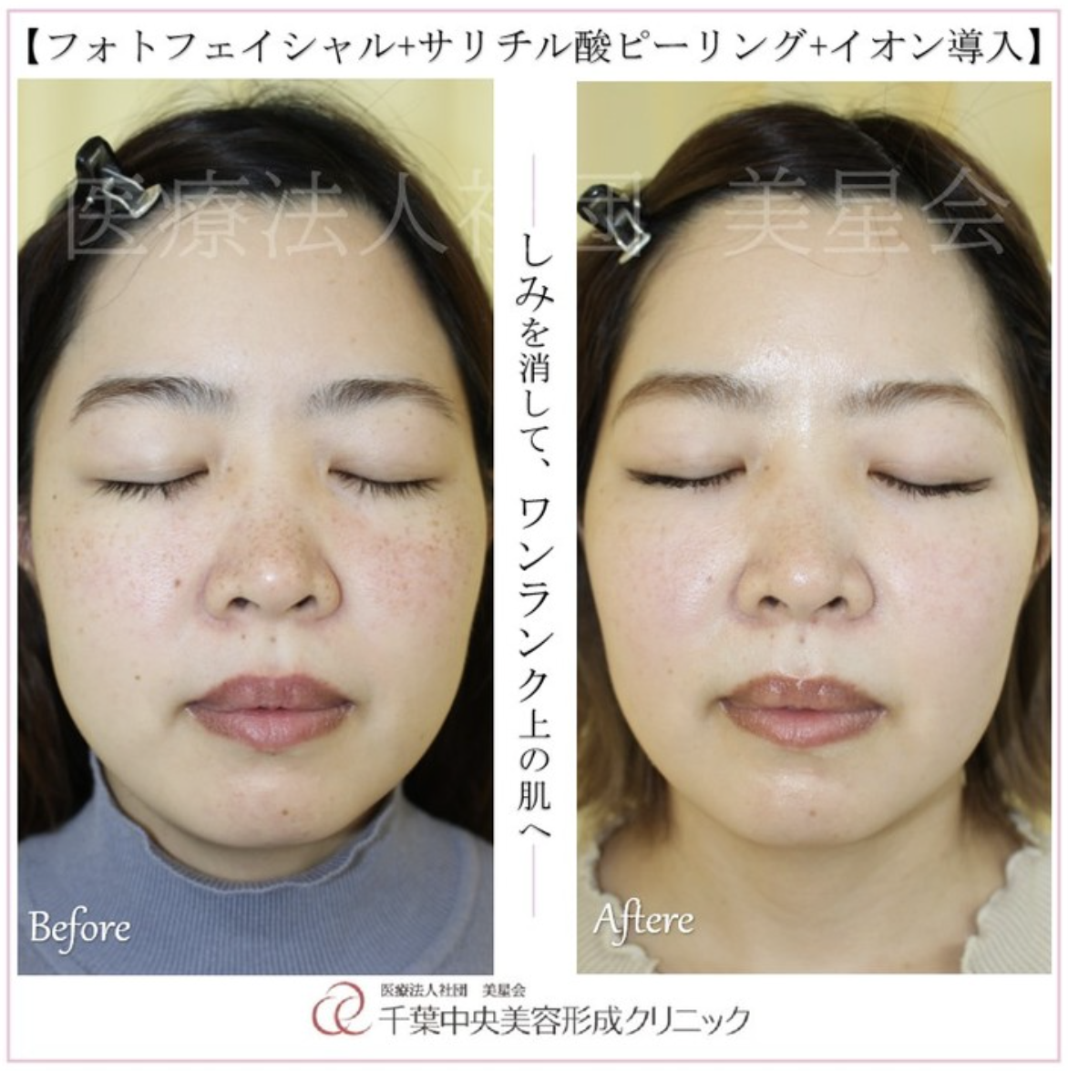 フォトフェイシャル・サリチル酸マクロゴールピーリング・イオン導入｜施行前と6回コース終了から1ヶ月後｜症例写真
