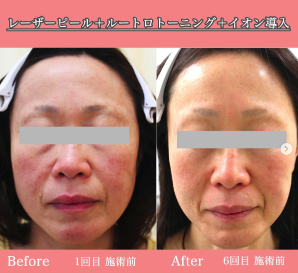 レーザーピール＋ルートロトーニング＋イオン導入｜症例写真｜ビフォーアフター