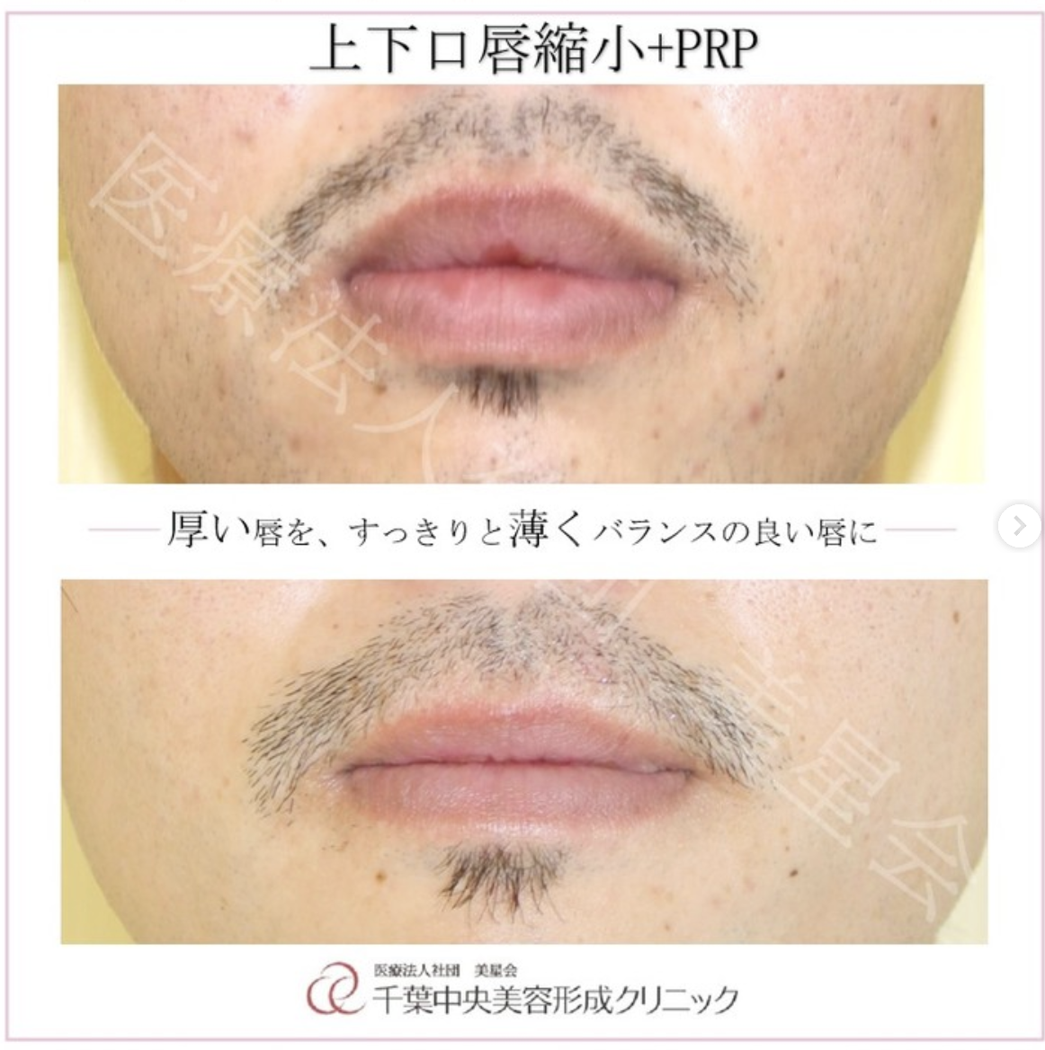 上下口唇縮小+PRP|症例写真|ビフォーアフター