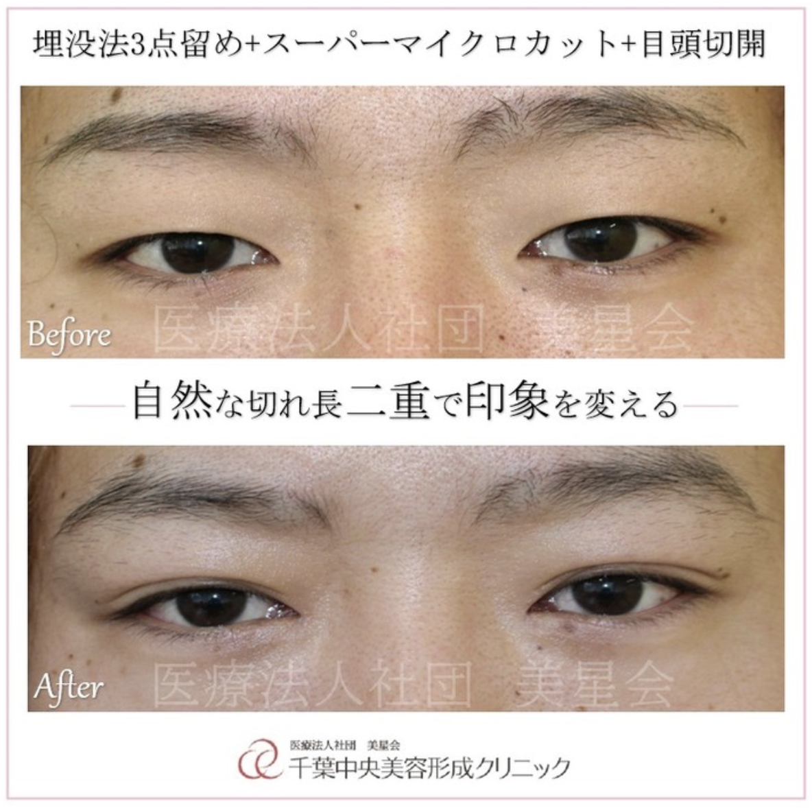 二重埋没法3点＋スーパーマイクロカット＋目頭切開｜症例写真｜ビフォーアフター