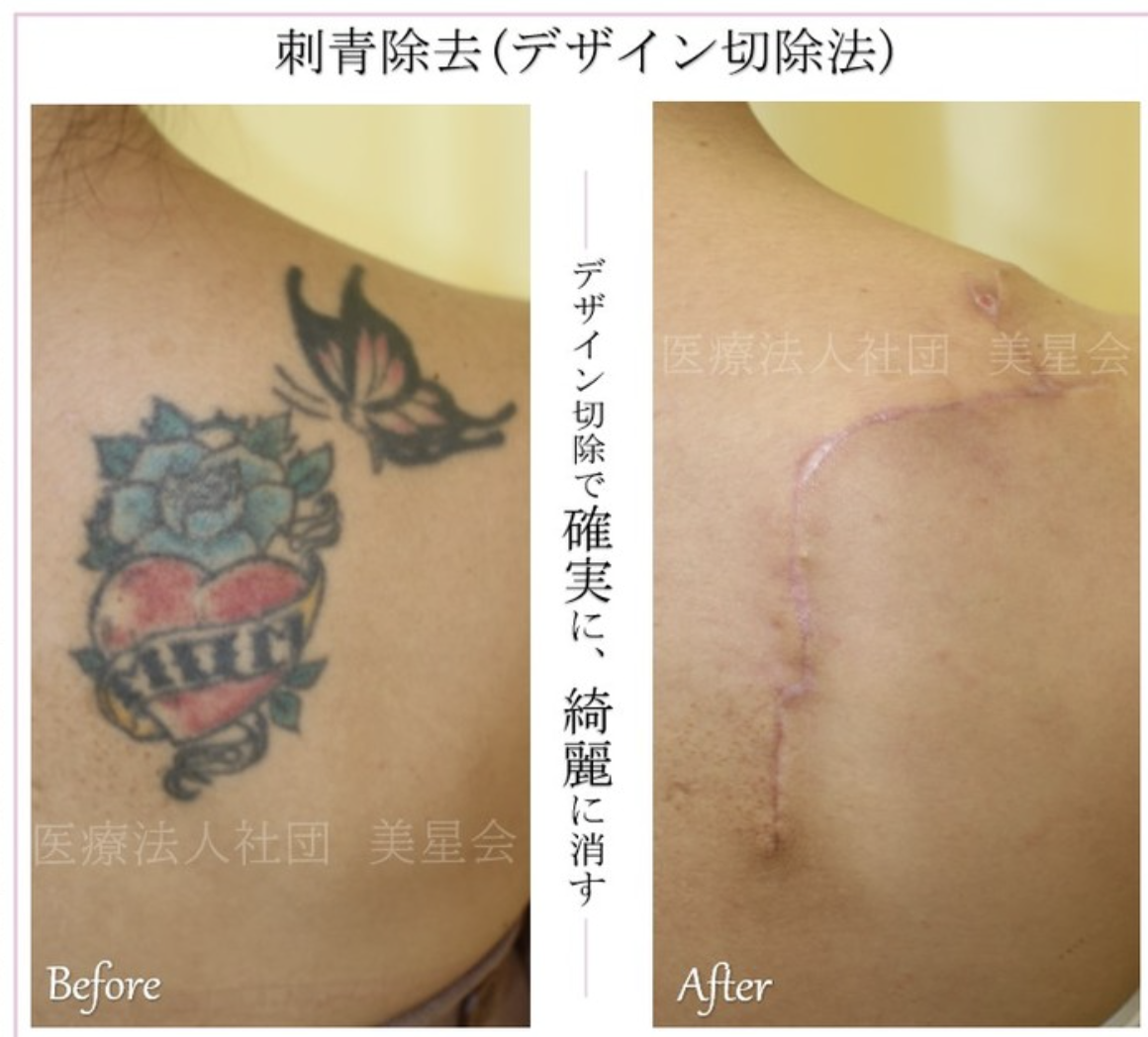 刺青除去(デザイン切除)|術前と1ヶ月後|症例写真