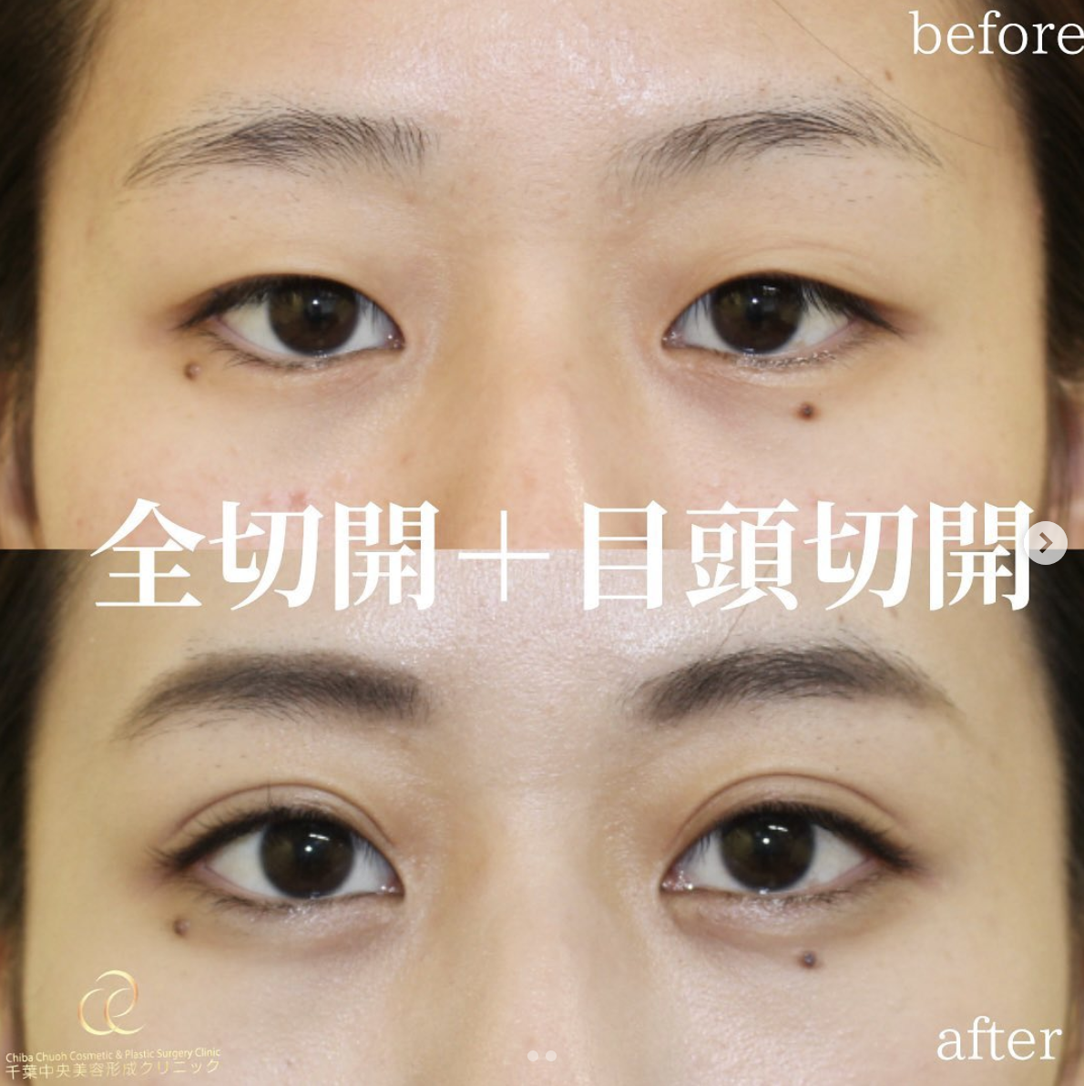 切開二重＋目頭切開＋PRP｜20代女性｜術後3ヶ月