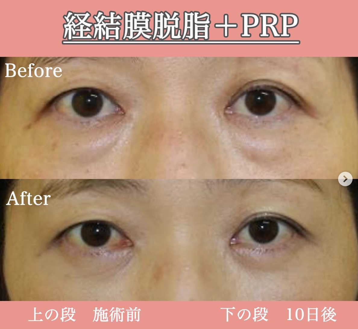 目の下の脂肪除去+PRP|症例写真|ビフォーアフター