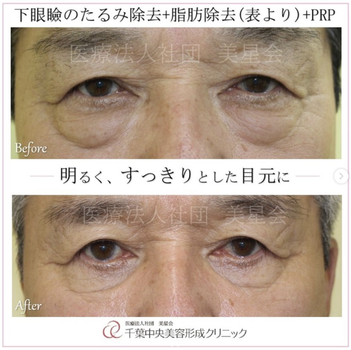 経結膜脱脂+たるみ除去+PRP|症例写真|ビフォーアフター