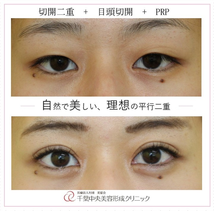 切開二重+目頭切開+PRP|症例写真|ビフォーアフター