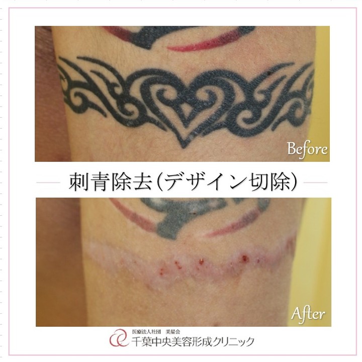刺青除去(デザイン切除)|症例写真|ビフォーアフター