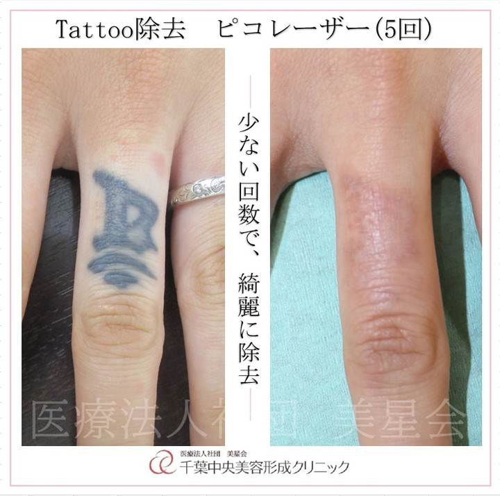 刺青除去(ピコレーザー)|症例写真|ビフォーアフター