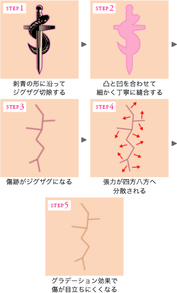 発汗抑制注射(多汗症治療)