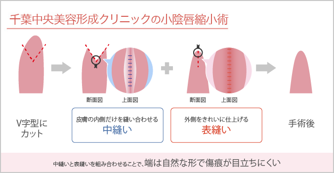千葉中央美容形成クリニックの小陰唇縮小術