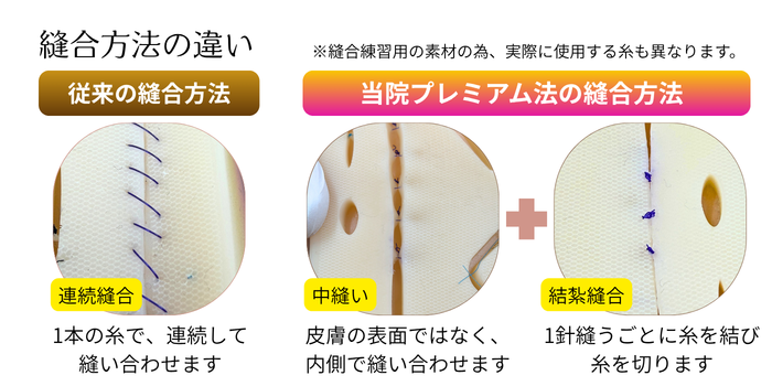 縫合方法の違い
