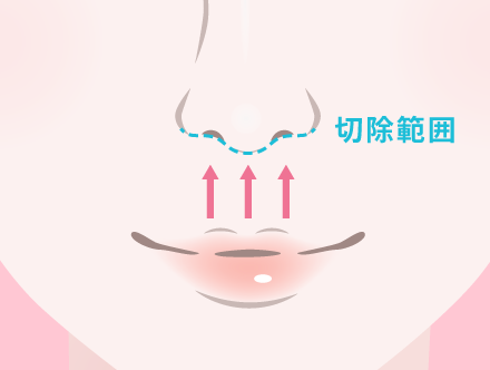 鼻の下を切開して引き上げる